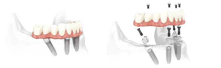 All-on-4 dental implant treatment Burlington